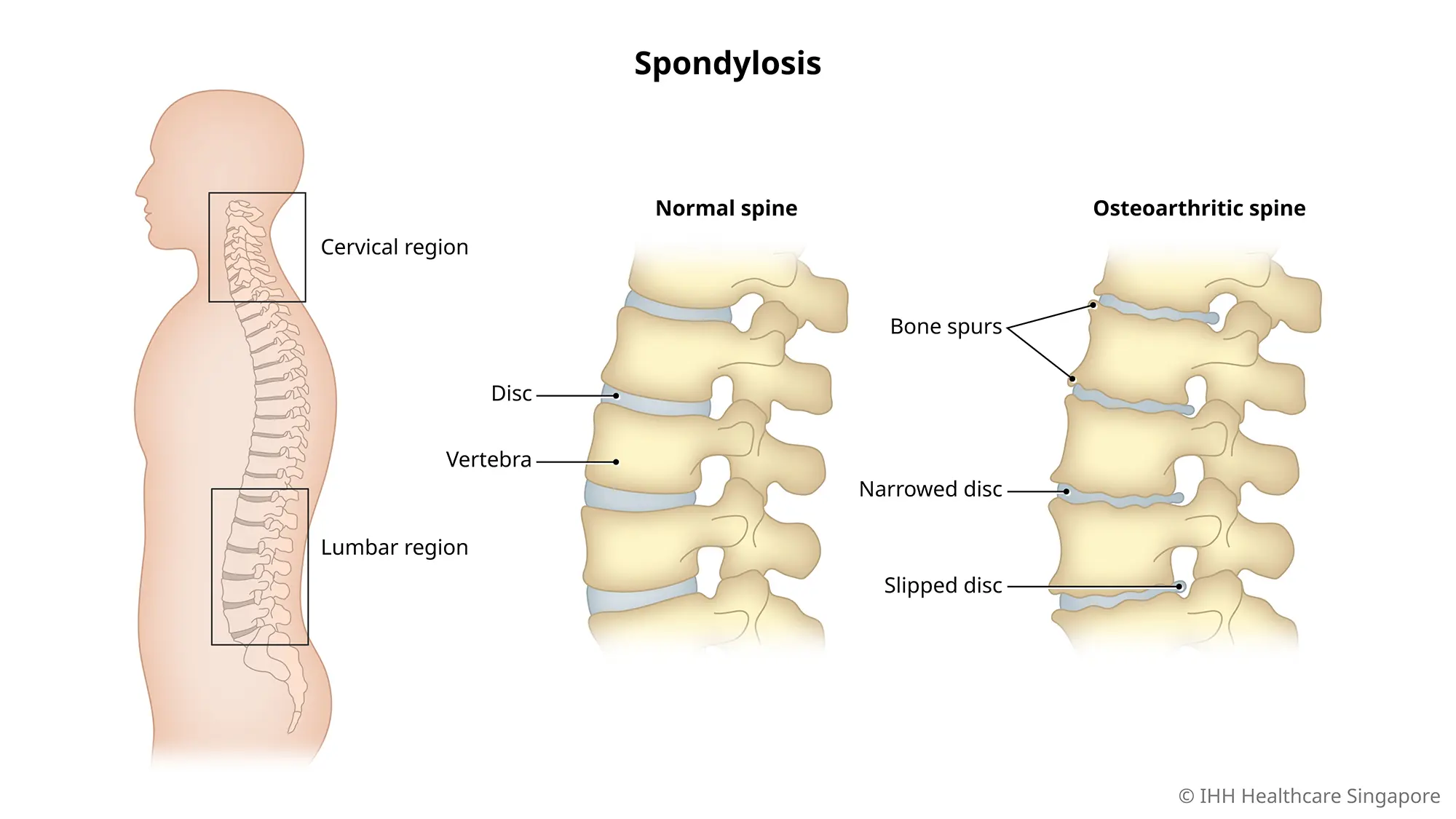 Lumbar Spondylosis