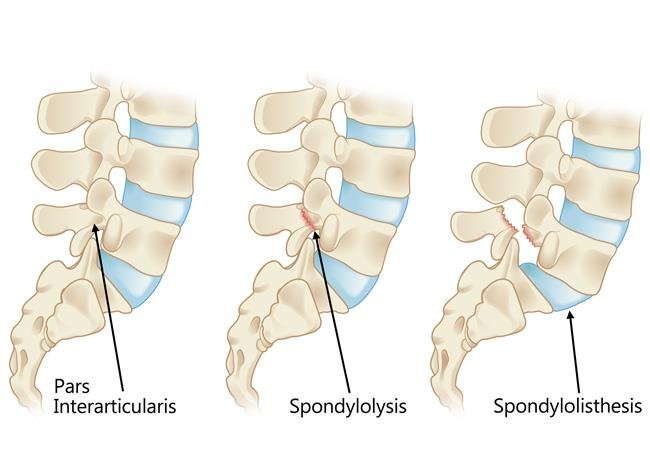 Spondylosis and Spondylolisthesis