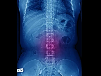 Spinal Infections and Tumors