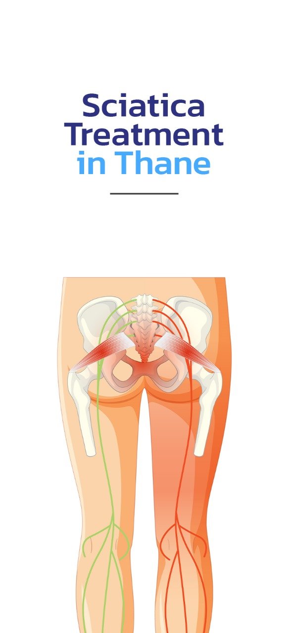 sciatica treatment in Thane