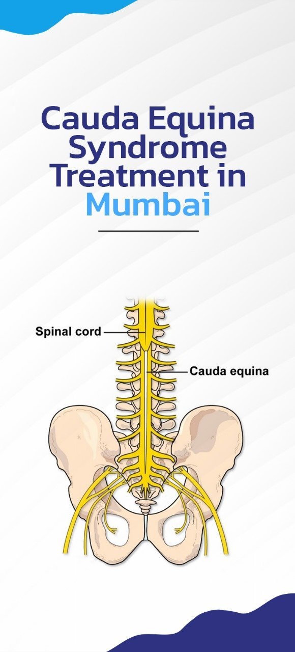 cauda equina syndrome treatments