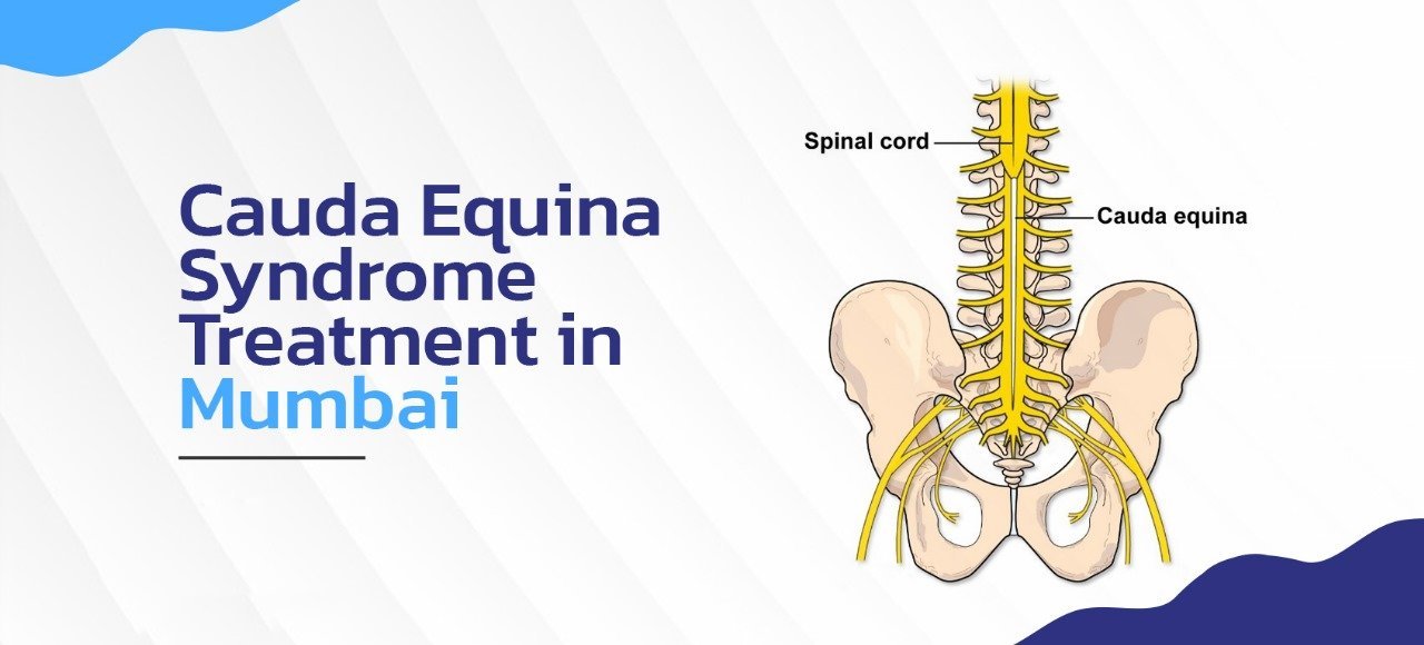 cauda equina syndrome treatments